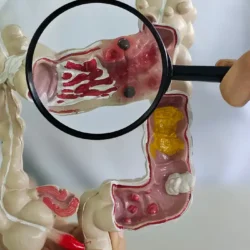 Em 13 anos, doença inflamatória intestinal cresce 5 vezes no Brasil Em 13 anos, doença inflamatória intestinal cresce 5 vezes no Brasil